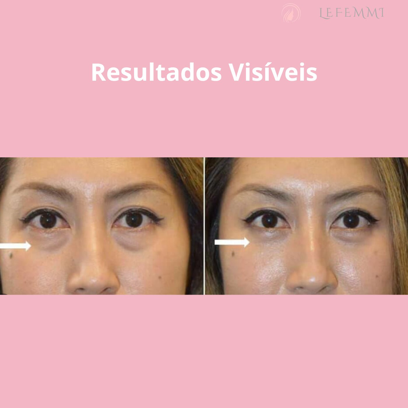 Glowup® Máscara para Redução de olheiras e rugas de expressão em Minutos - LeFemmi